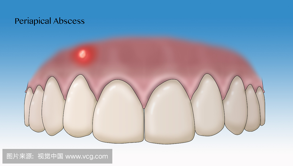 根尖脓肿,例证