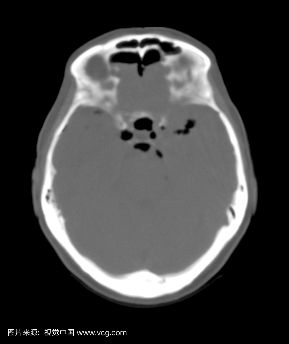 一个持续严重头部创伤的头部的这种轴向CT图