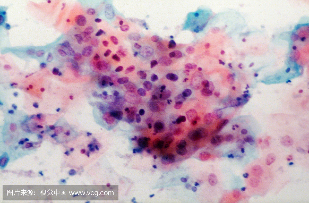 宫颈细胞学染色在CIN中。这种细胞学准备显示