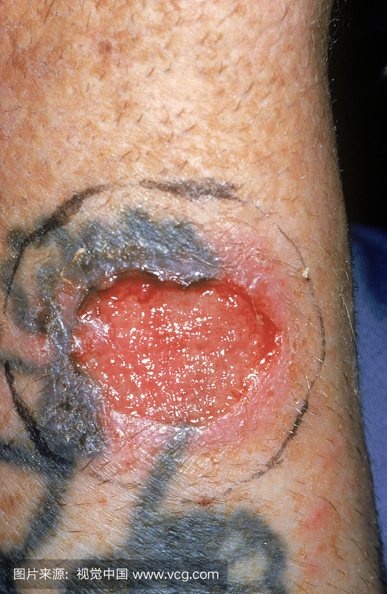 基底细胞癌是皮肤癌中最常见的皮肤癌形式。它