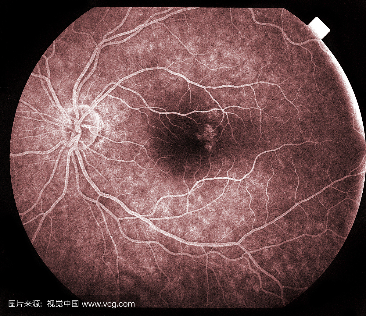 视网膜的荧光素(或荧光)血管造影检查显示视网