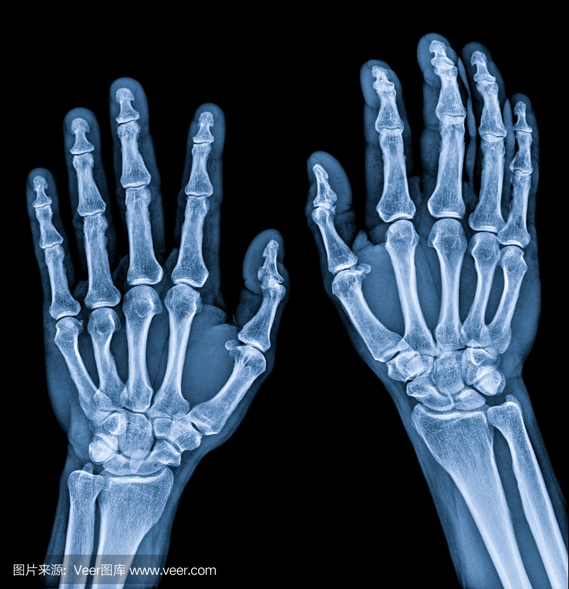 正常男性手部X射线双方都以蓝色调过程