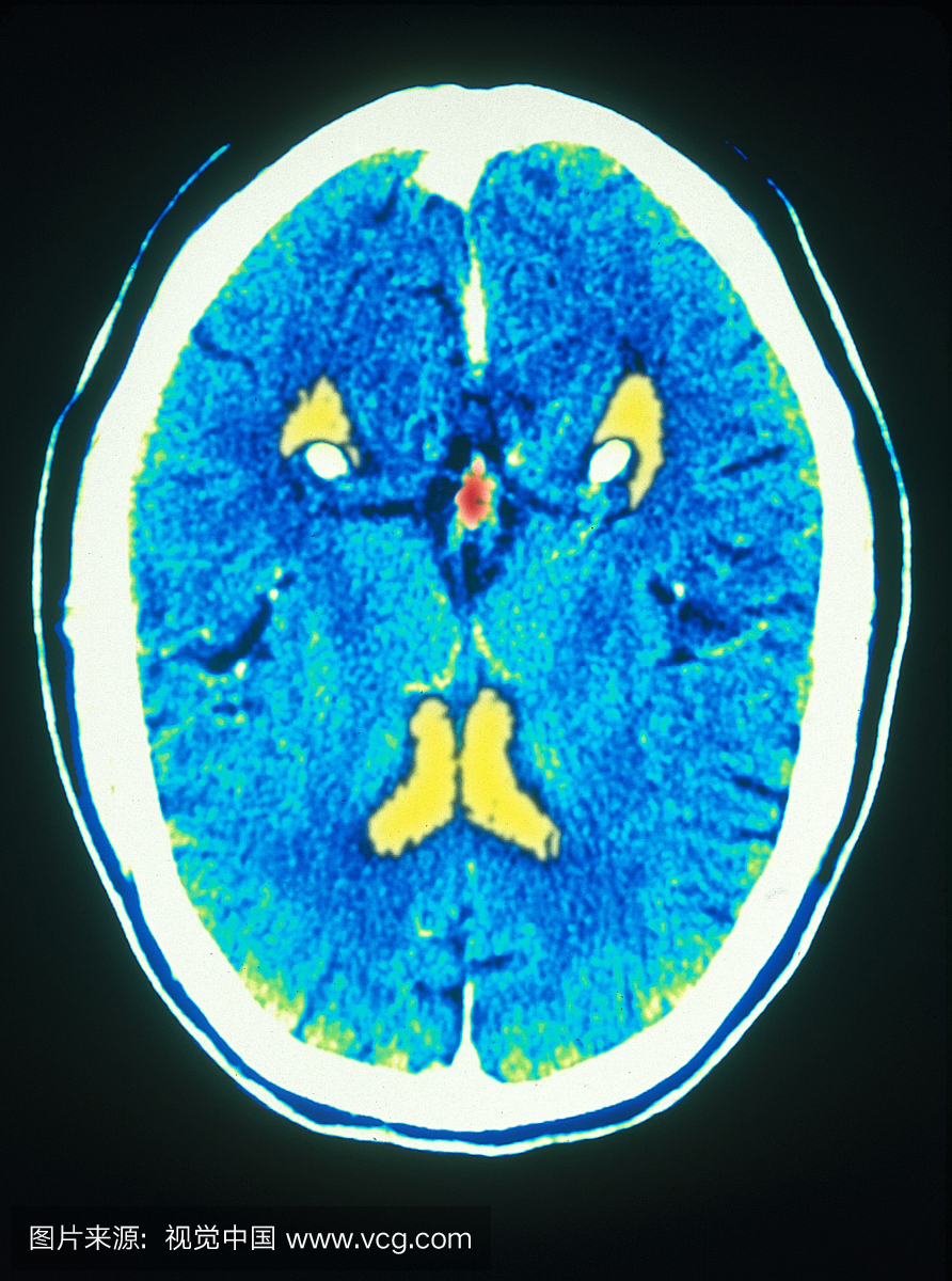 CT扫描人脑。轴向视图显示脑室和松果体。