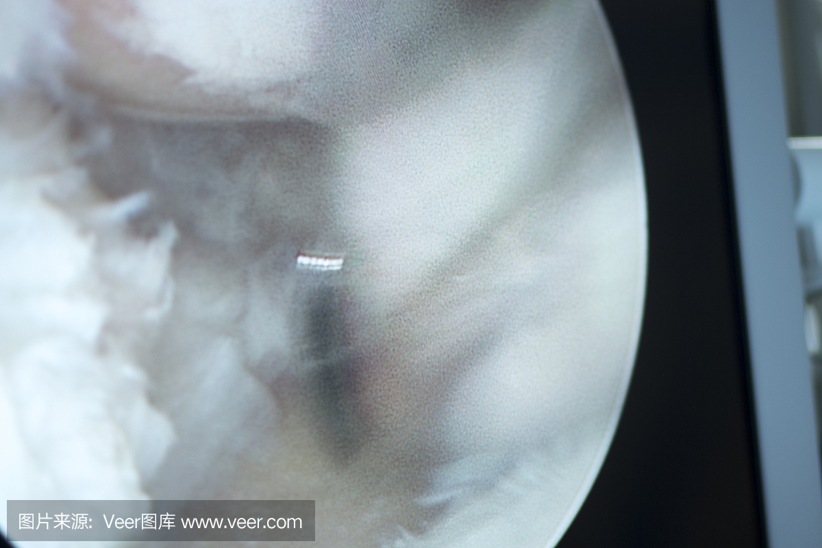 关节镜手术屏幕显示关节镜相机图片在膝关节半