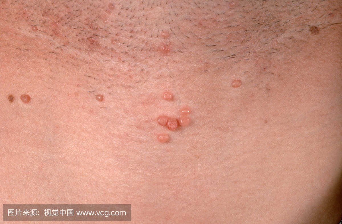 软疣传染性疣状皮肤病变,儿童中最常见的痘病