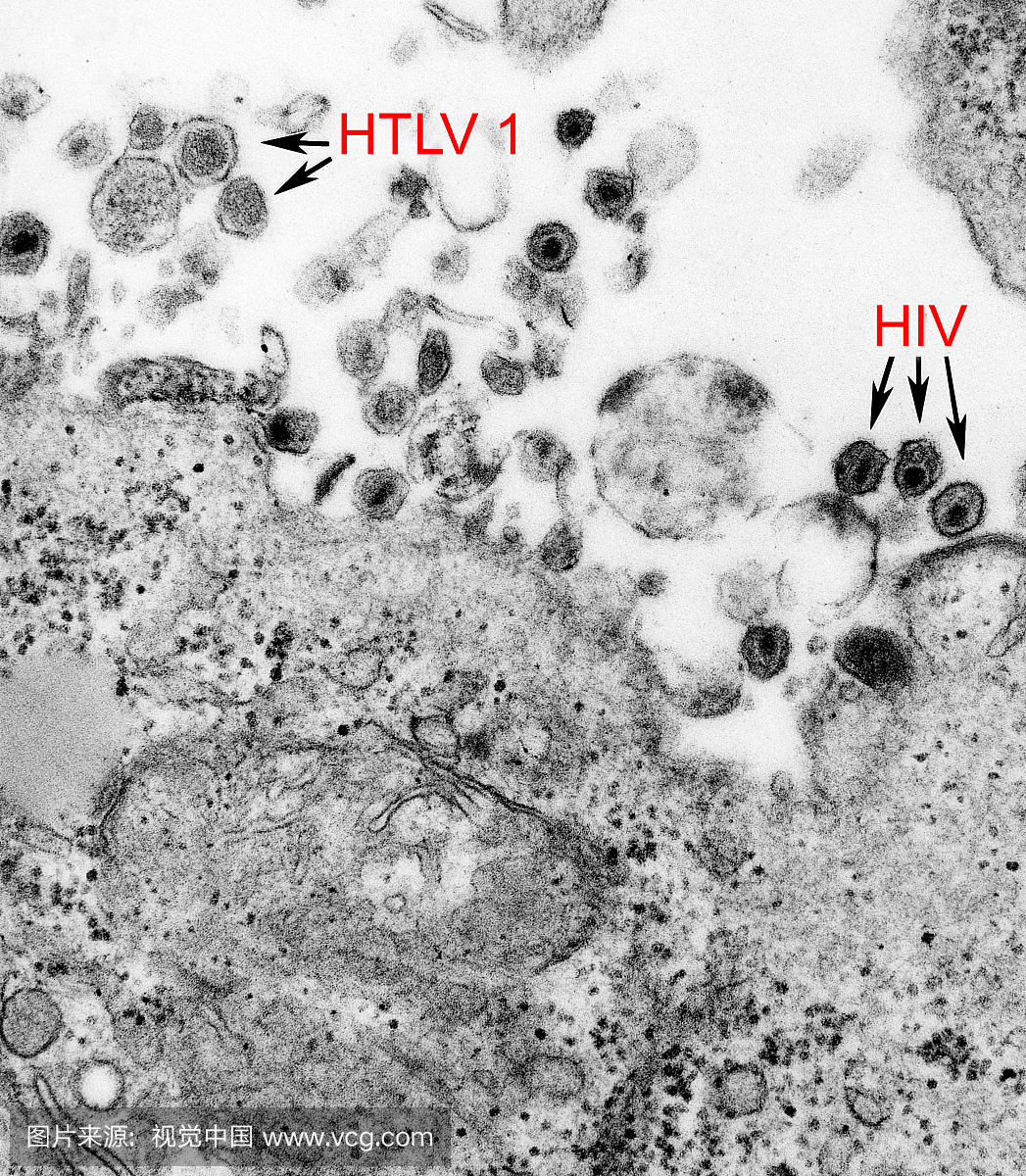 HTLV-1和HIV,TEM