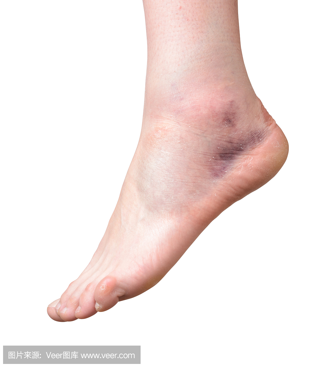 扭伤,拉伤,扯伤,损伤