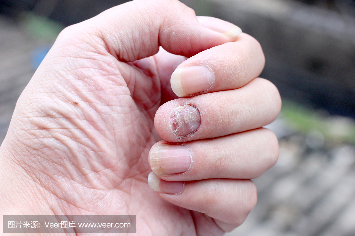 真菌感染指甲手,手指与甲真菌病。