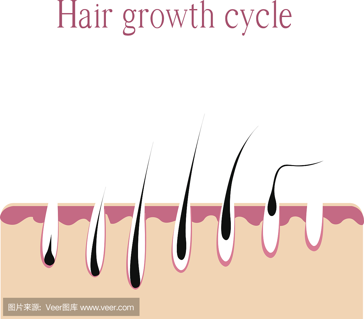 毛发生长周期。脱发雄激素性脱发。