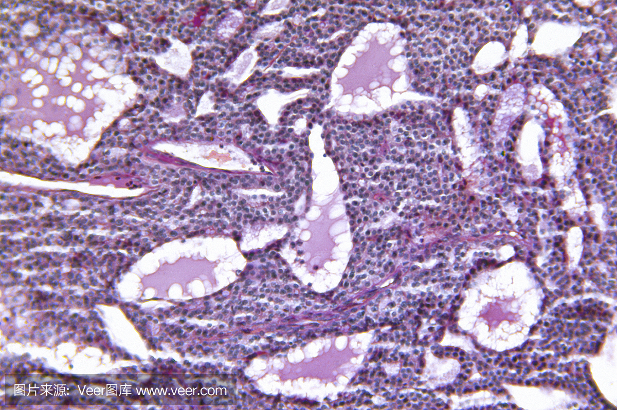 扩大甲状腺腺瘤性增生