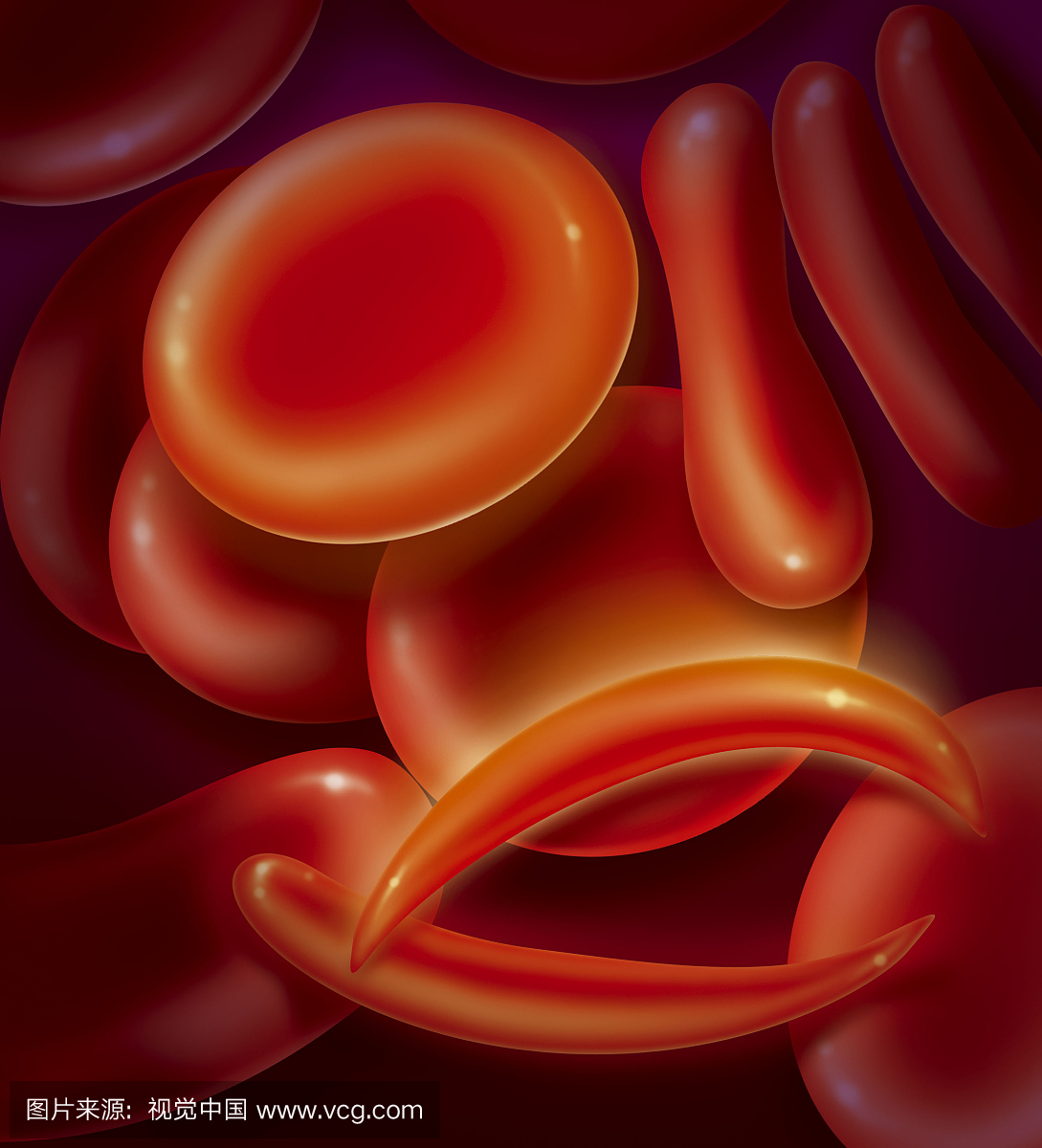 免疫球蛋白血症或镰状细胞性贫血,插图
