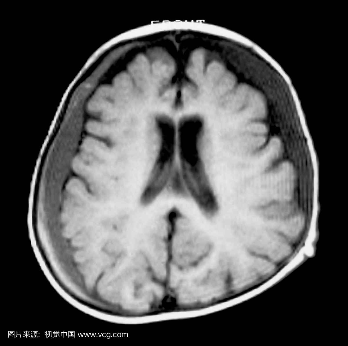 儿童脑部的轴向(横截面)MRI视图显示双侧硬膜