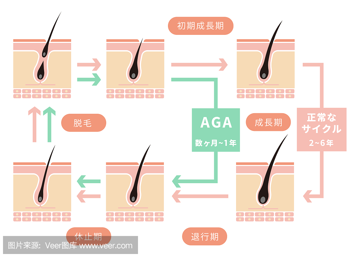 正常毛发周期和AGA(雄激素性脱发)\/日本人的比