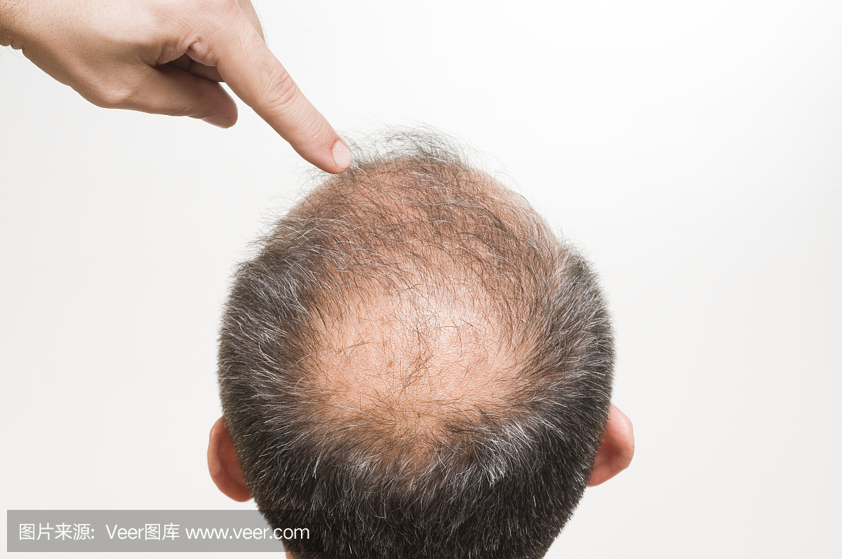 后脑勺,后脑,秃顶,谢顶