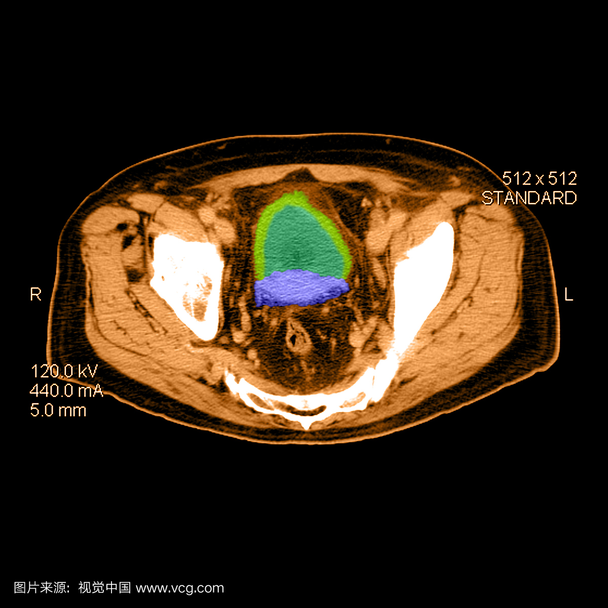 彩色增强轴突(横断面)CT图像穿过前列腺癌患者