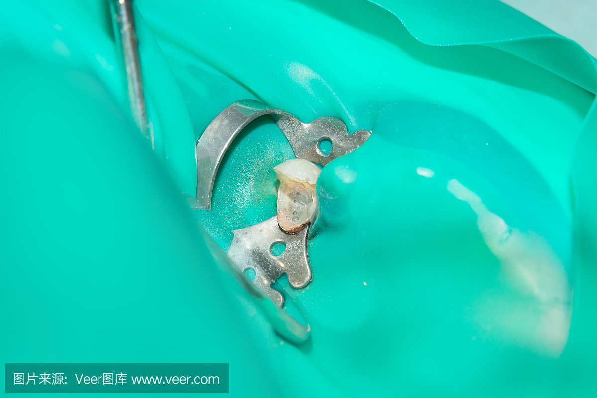 牙齿特写的根管治疗。清洁牙齿的根部及其填充