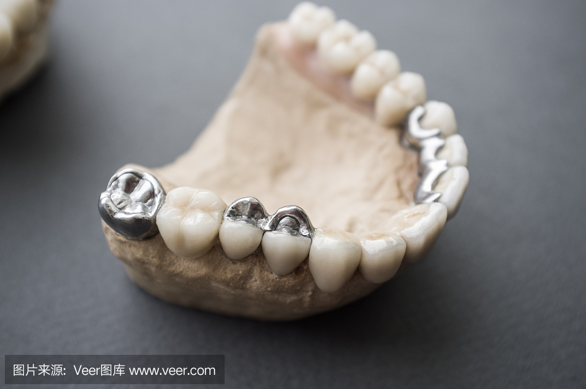 人的颌骨布局与陶瓷和金属假牙