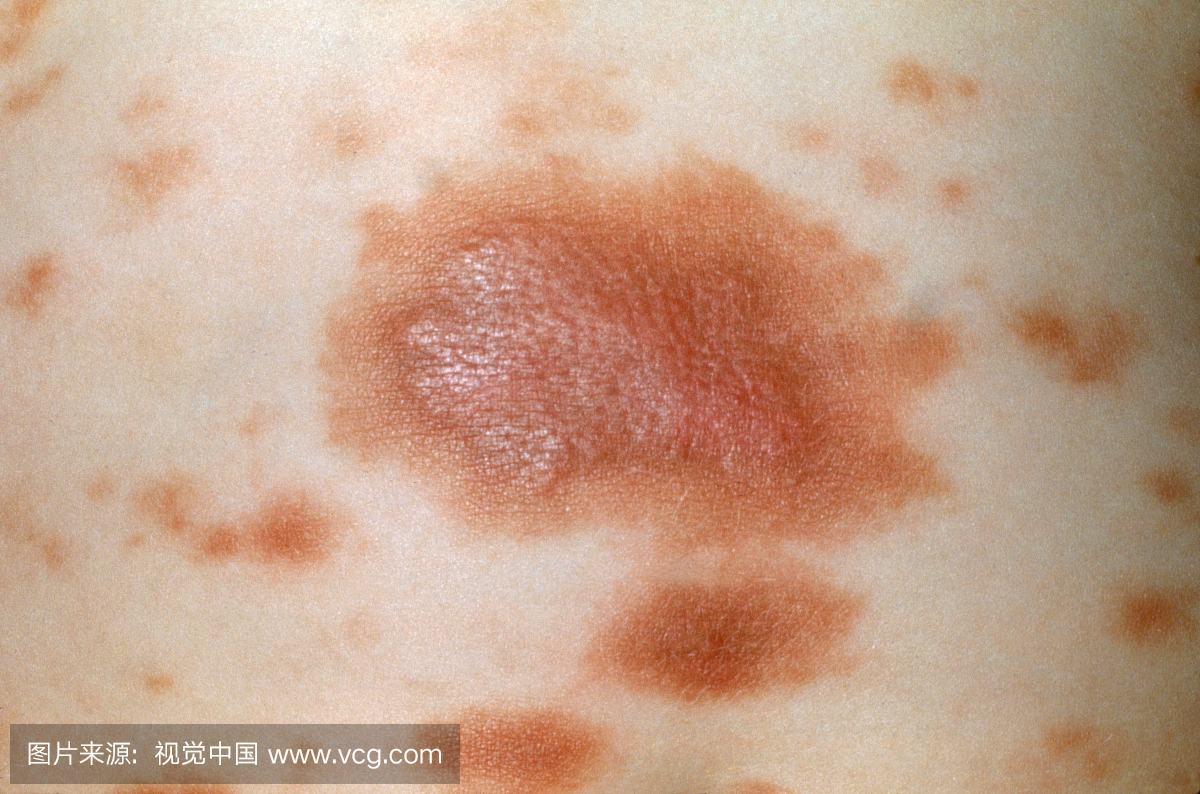 荨麻疹色素性荨麻疹是一种罕见的疾病,会产生