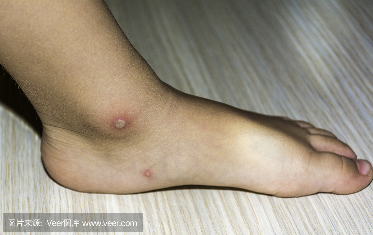 近距离拍摄水痘病毒或水痘泡沫疹儿童腿或脚。