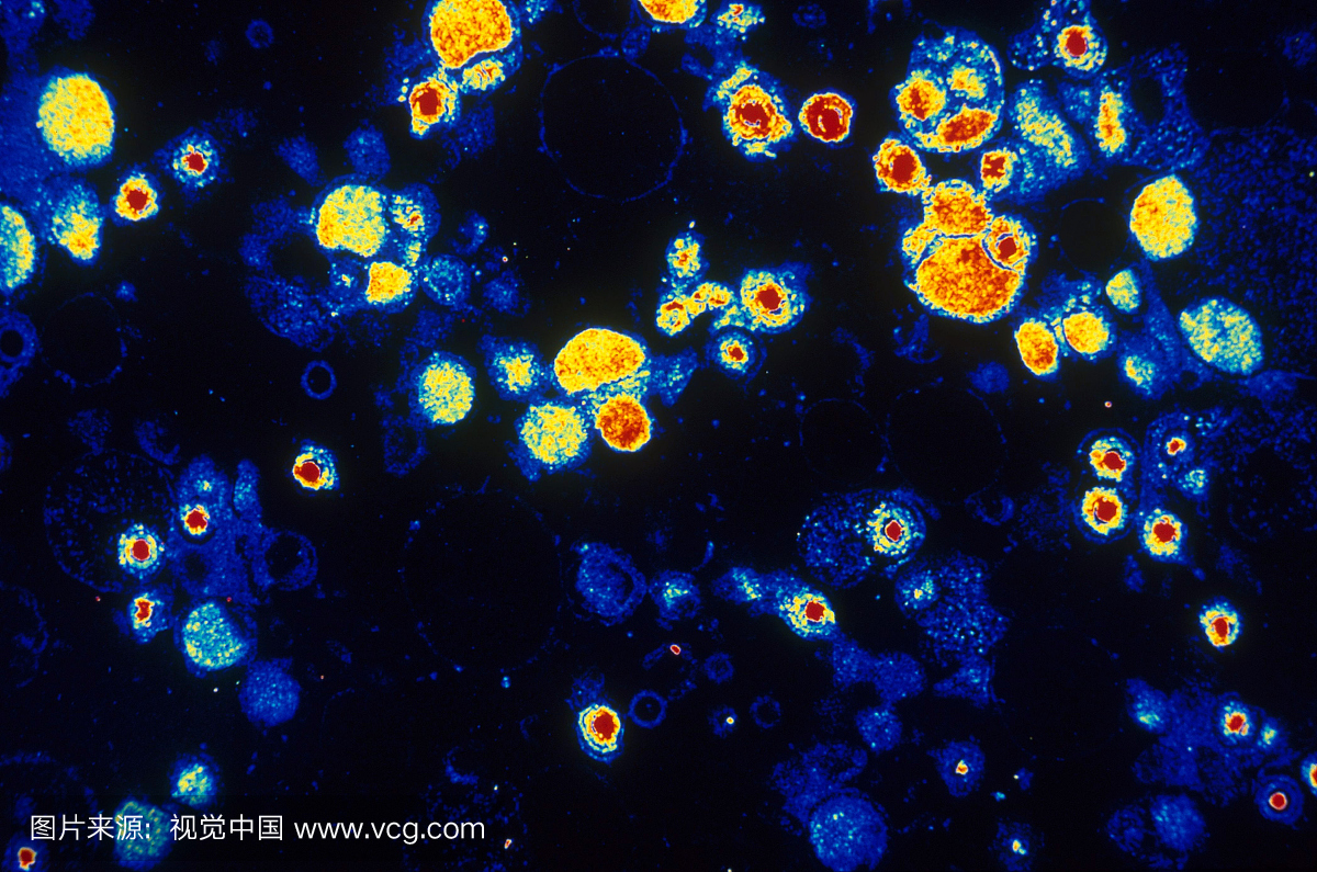 巨细胞病毒的彩色增强透射电子显微镜是一种艾