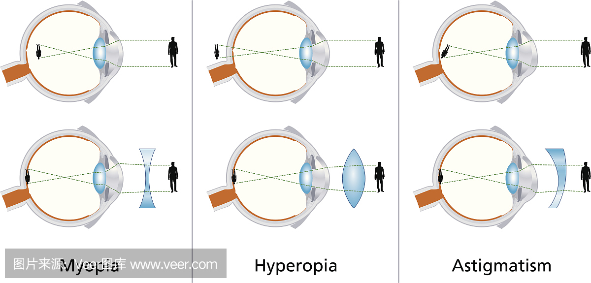 视觉缺陷 - 近视，远视和散光