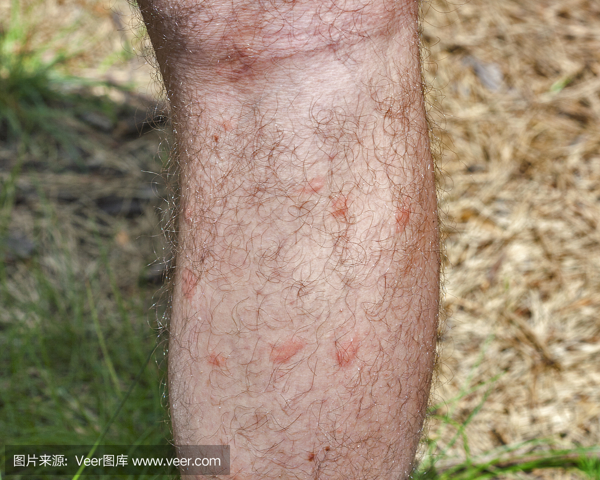蚊子叮咬在人腿上的痕迹