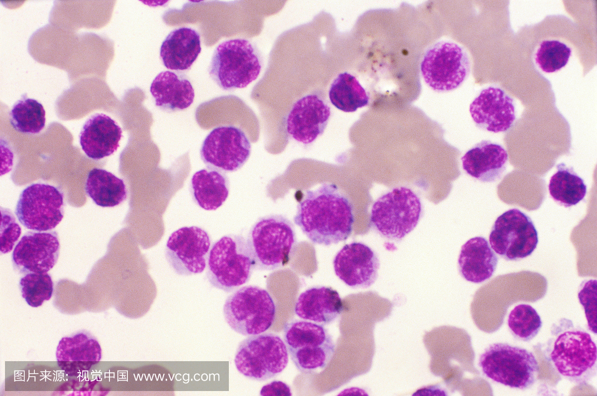 单核细胞白血病(Meylo单核细胞白血病)的血液