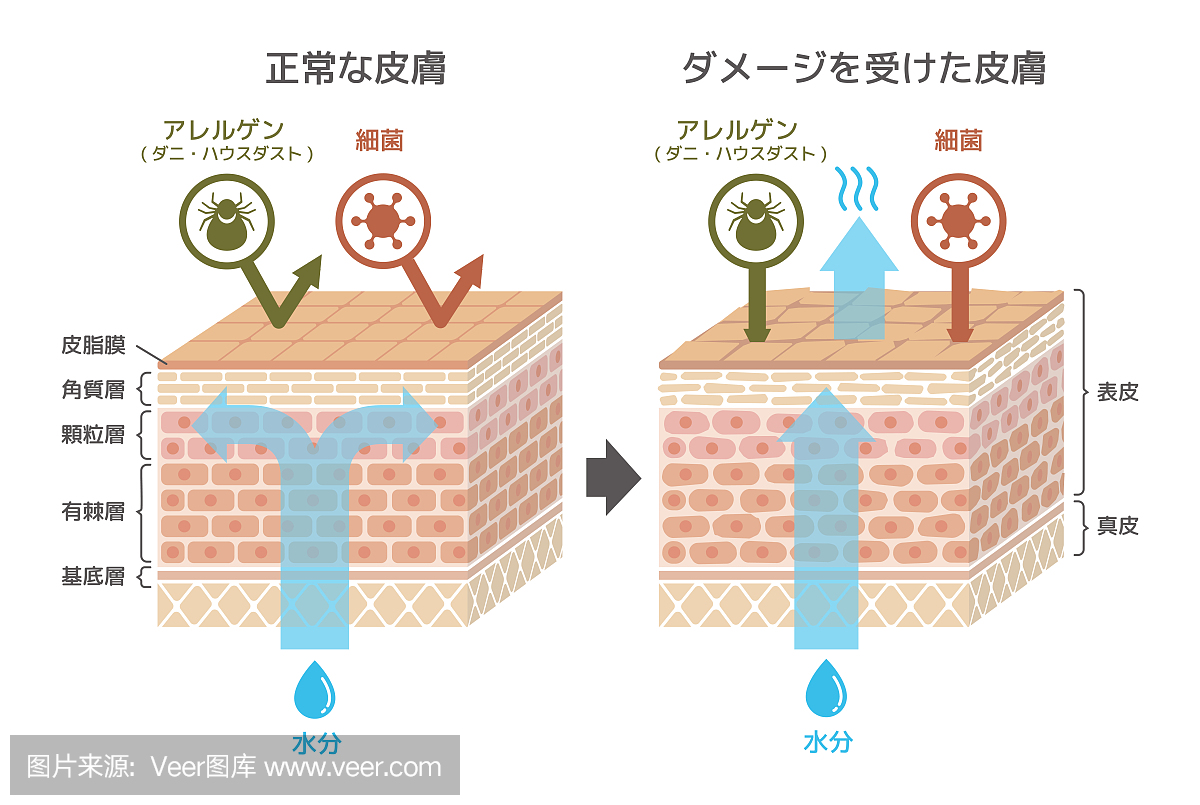 皮肤断面图。健康皮肤与受伤皮肤保护效果对比