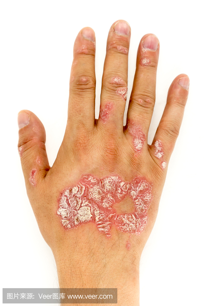 牛皮癣在人的手和手指指甲与斑块,皮疹和补丁