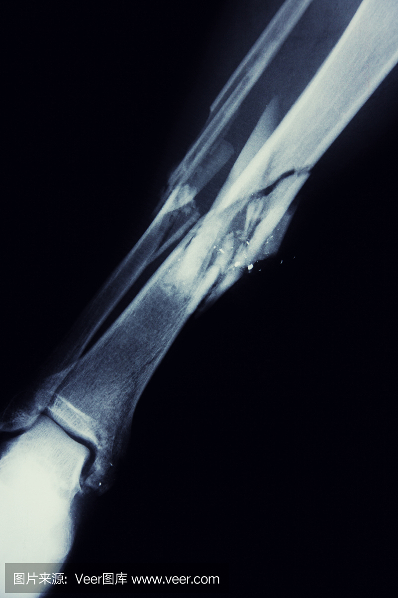 一个堕落黎明的男人的碎腿X光片