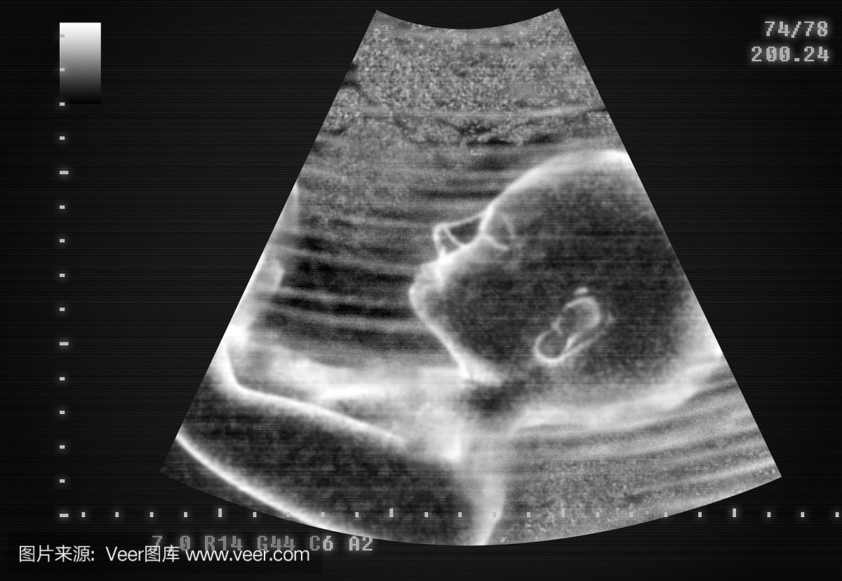 7个月胎儿超声