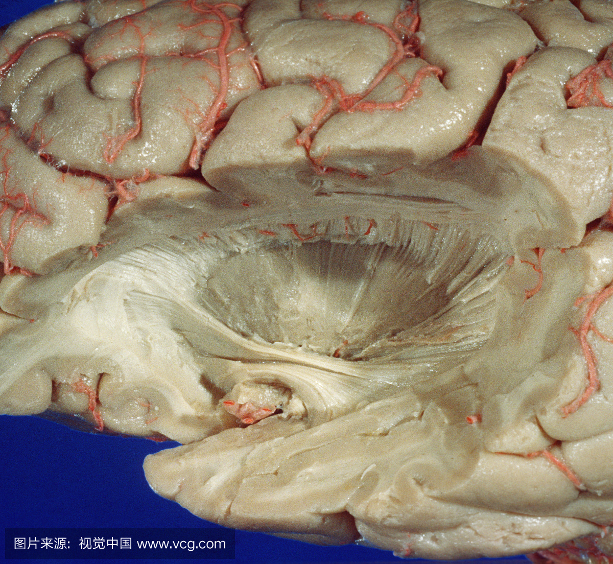 脑 - 左外侧,解剖松果体核。