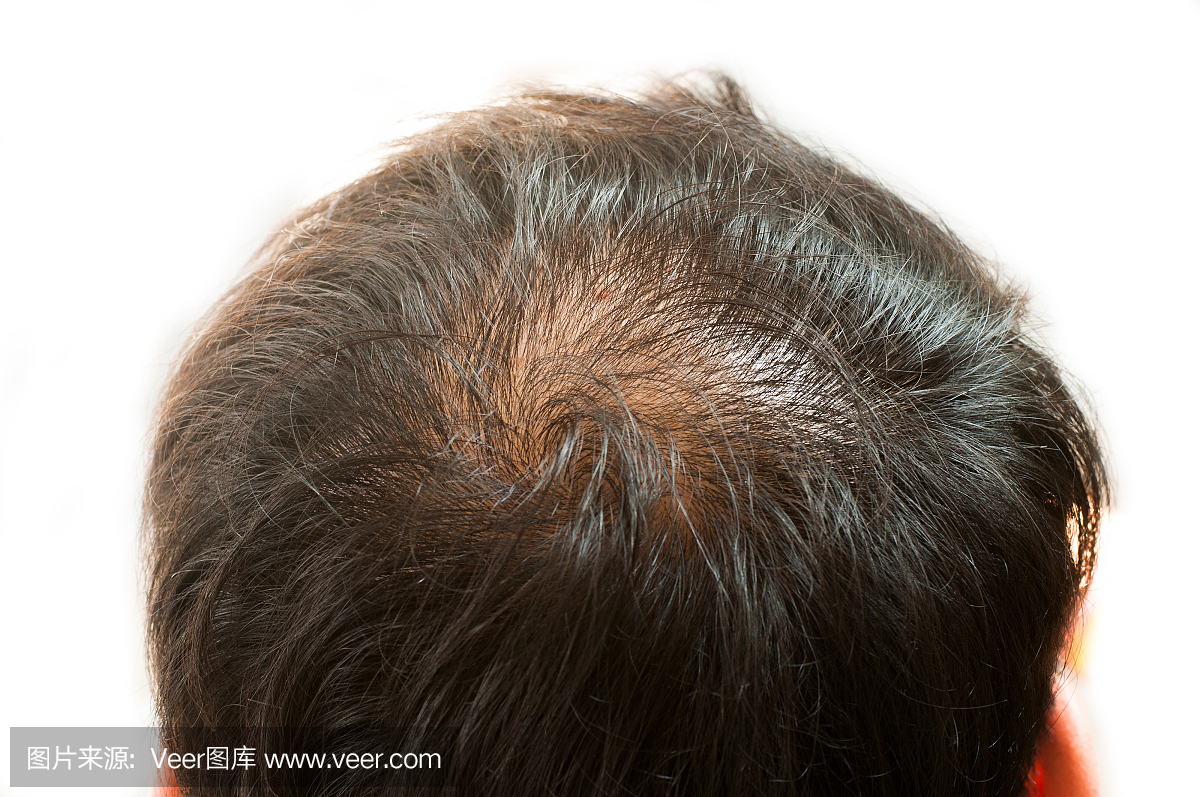 脱发,头发和头皮变稀