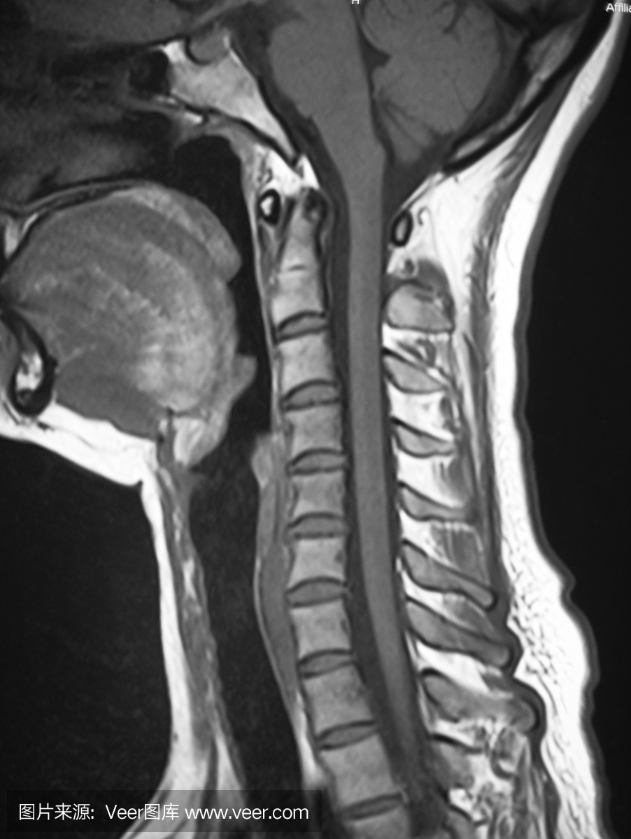 人类颈椎磁共振图像(MRI)