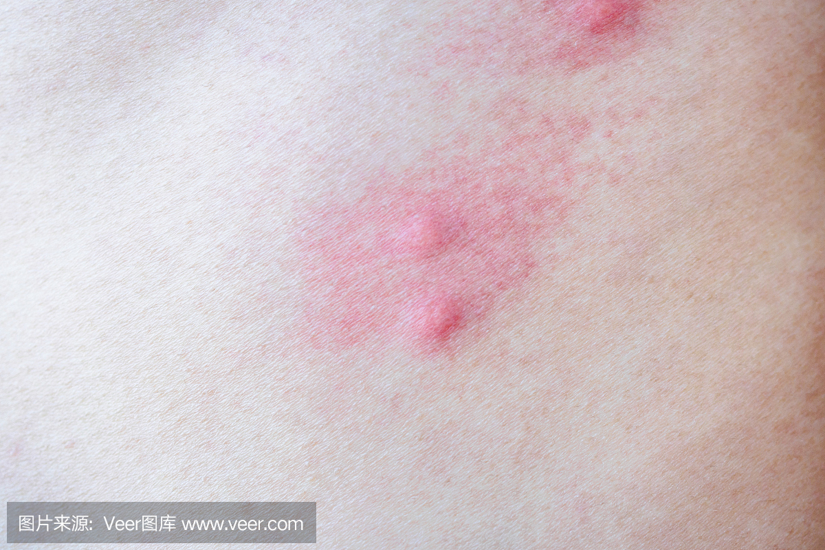 蚊虫叮咬引起皮肤过敏