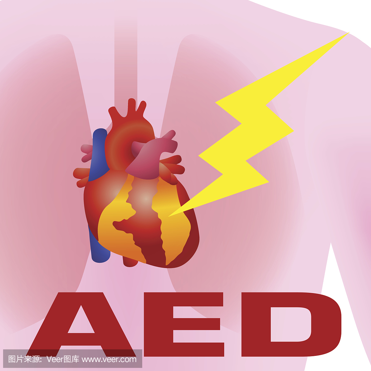 除颤器,自动外部除颤器(AED)