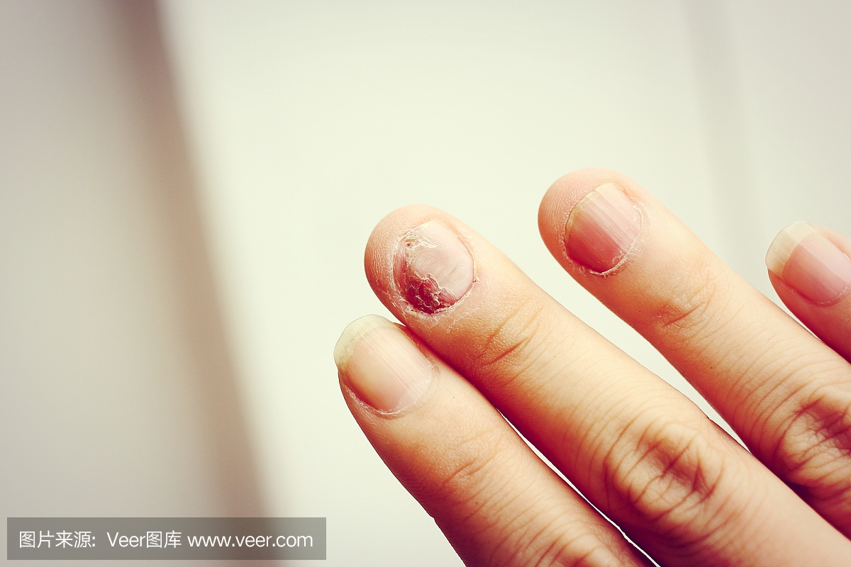 真菌感染指甲手,手指与甲真菌病。 - sof