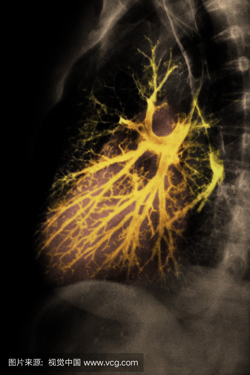 健康肺支气管图。支气管造影通过将无线电不透