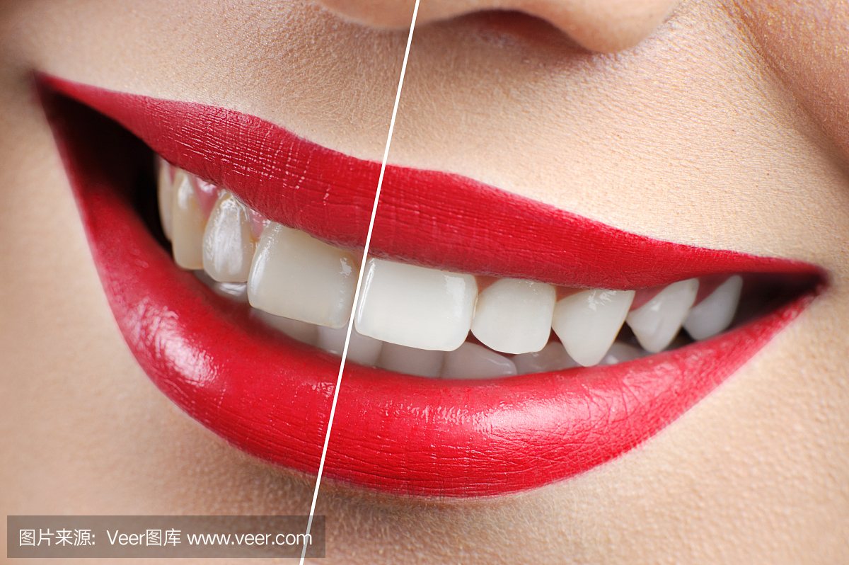 之前和之后拍摄的红唇女人牙齿美白