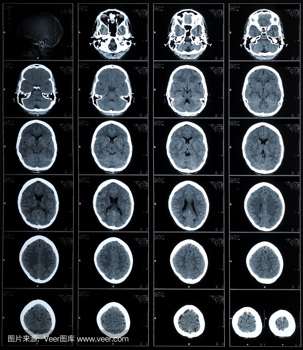 人脑CT摄影
