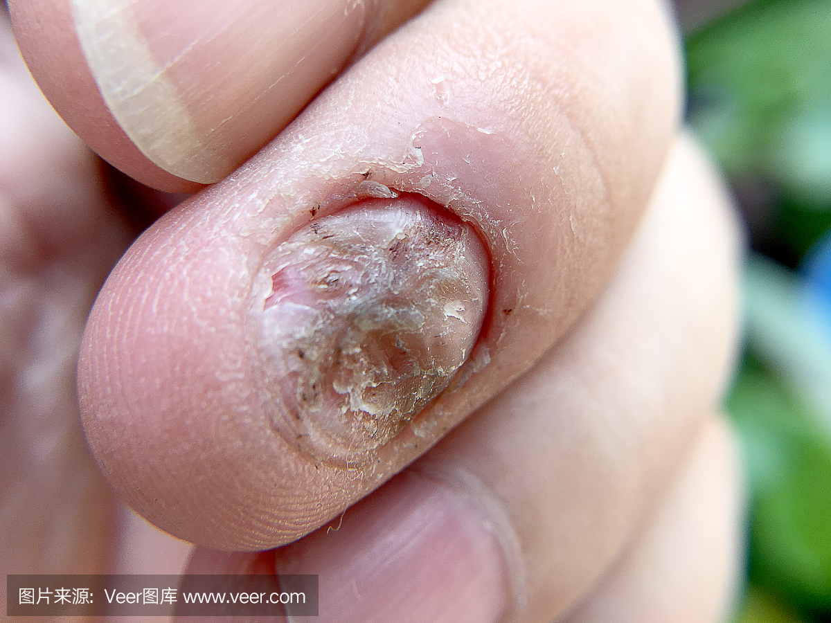 真菌指甲感染和人的手损伤。