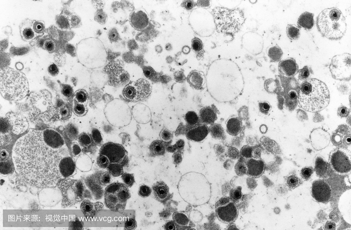 巨细胞病毒的透射电子显微镜(TEM)放大49.2万