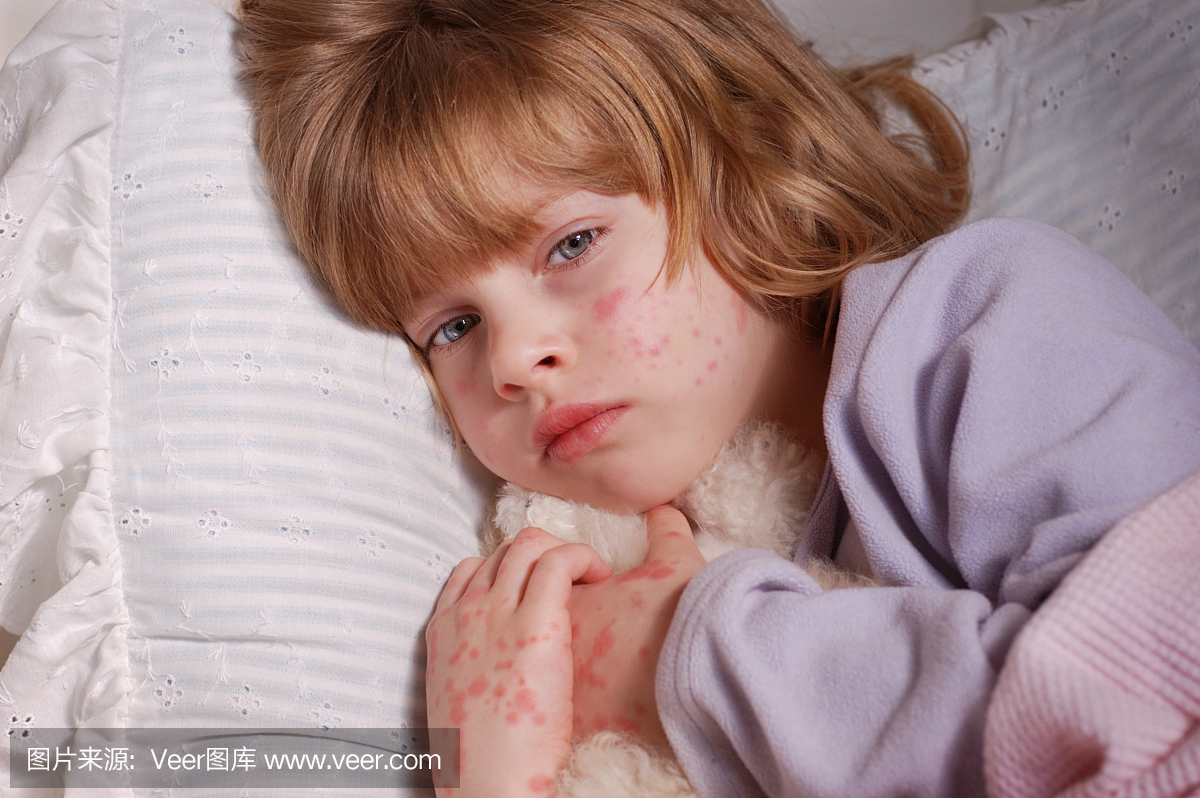 一个非常生病的小女孩,脸上和手上有红疹