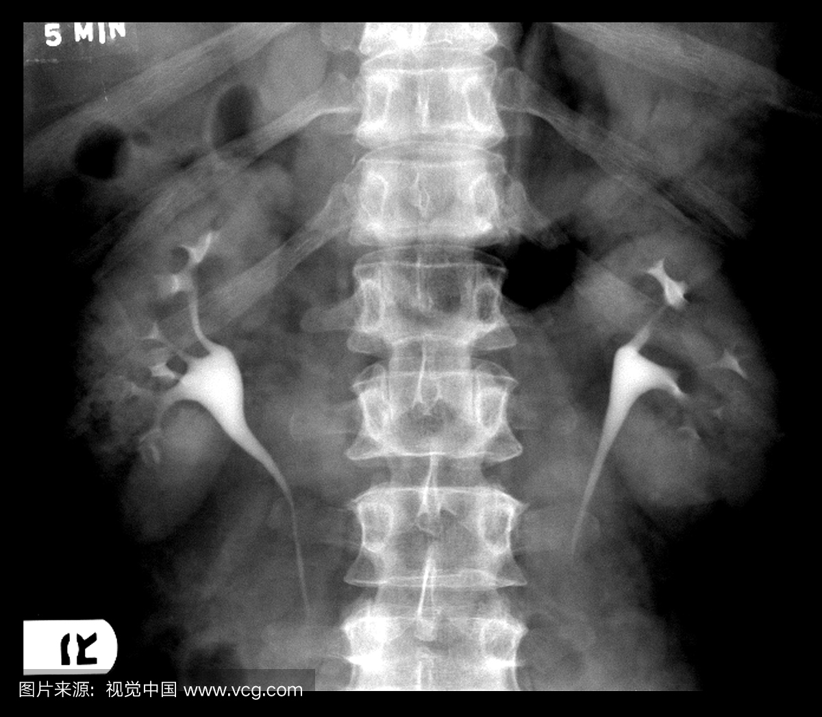 来自IVP(静脉注射白血病)腹部的正面X射线照射