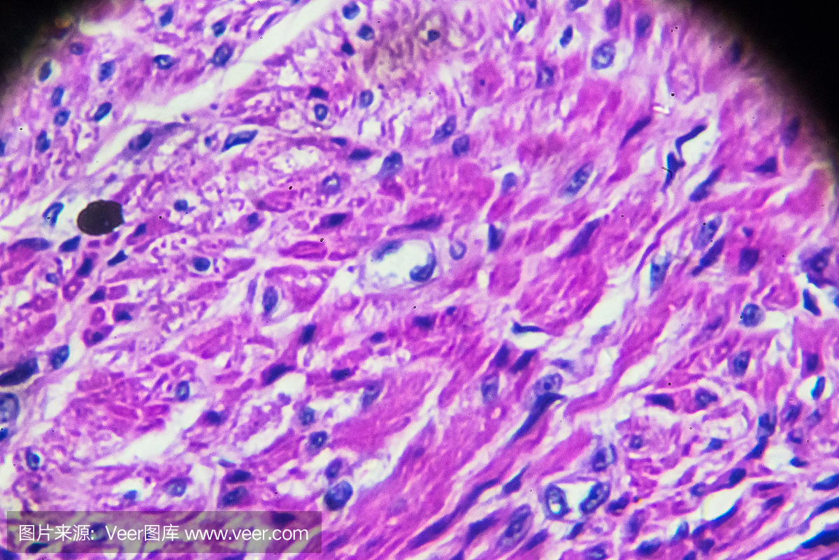 Carcinoma of endometrium bio sample under m