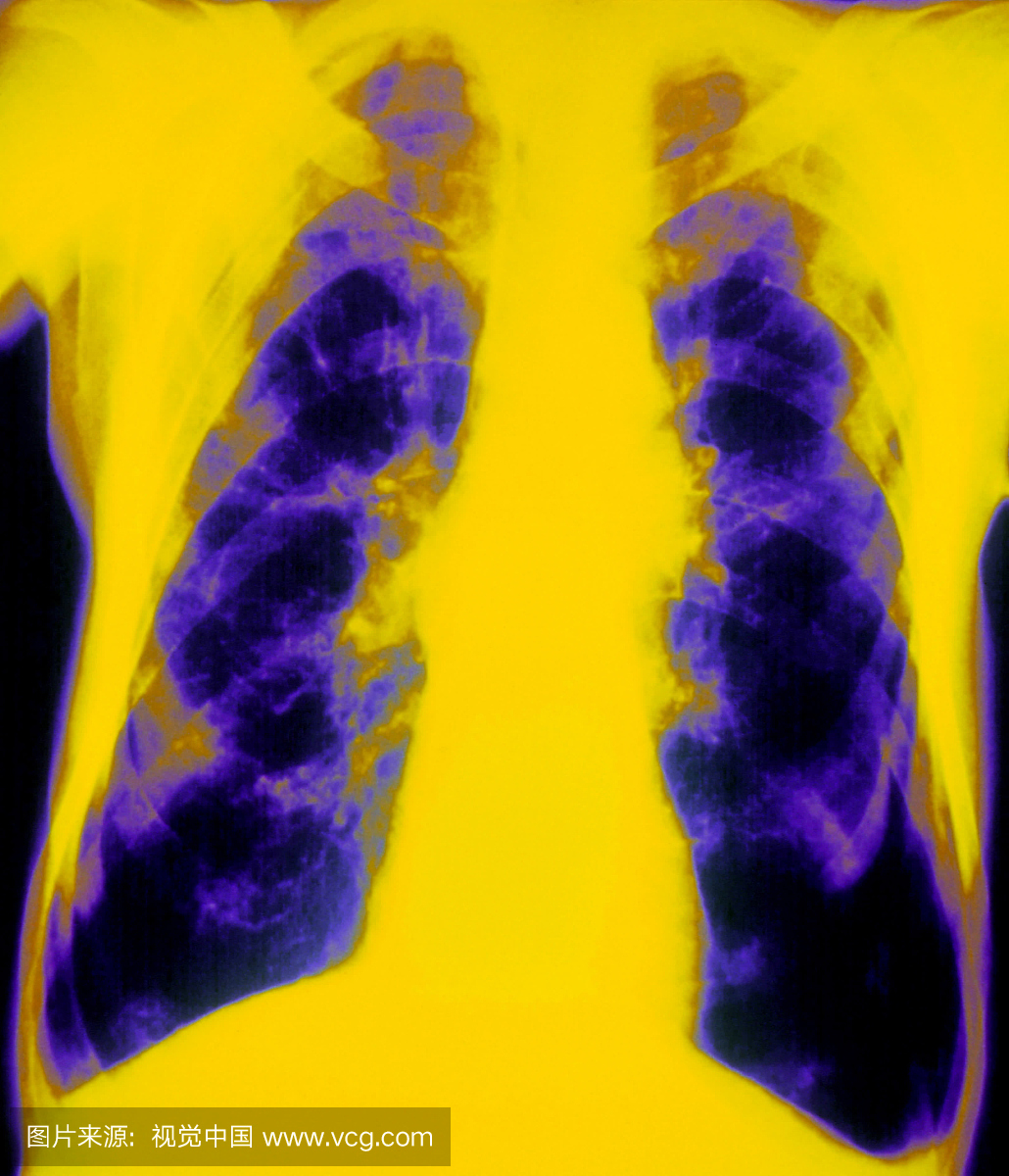 慢性阻塞性肺纤维化胸片X线片